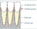 Tandkødsbetændelse og parodontose